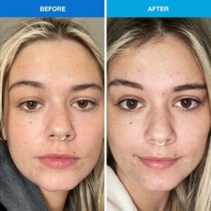 acne before after