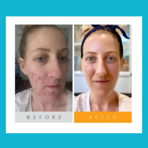 acne before and after