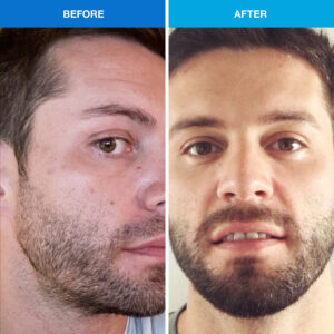 acne clear skin before after