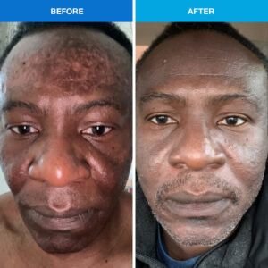 before after acne