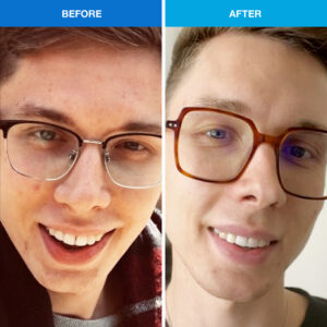 before after acne product