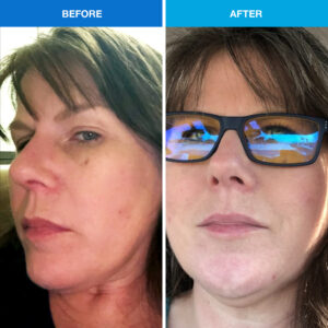 before after clear skin vitamedica