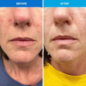 before and after acne