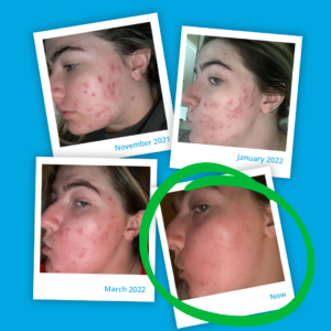 befre after acne