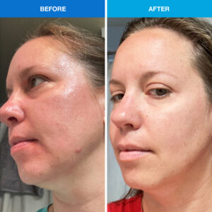 clear skin before after