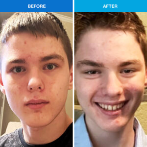 clear skin before and after
