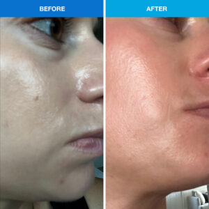 clear skn acne
